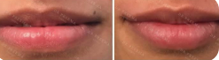 Dezente Lippenvergrößerung